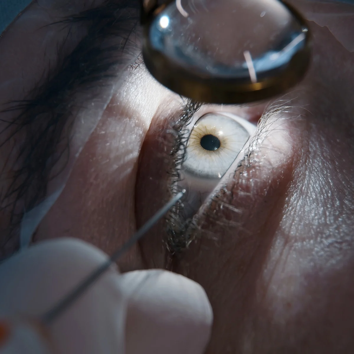 Placement of the monofocal implant.